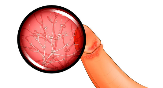 ¿La balanitis tiene cura? Descubre cómo tratarla sin miedo ni vergüenza